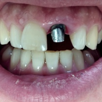 Wiederherstellung eines gebrochenen Zahn , Stiftaufbau